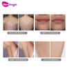 Top Professional Laser Hair Removal Machine Manufacturers in China