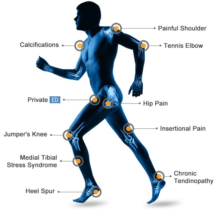 Newangie Soft Shockwave Knee Therapy Machine Pain Stem Cell