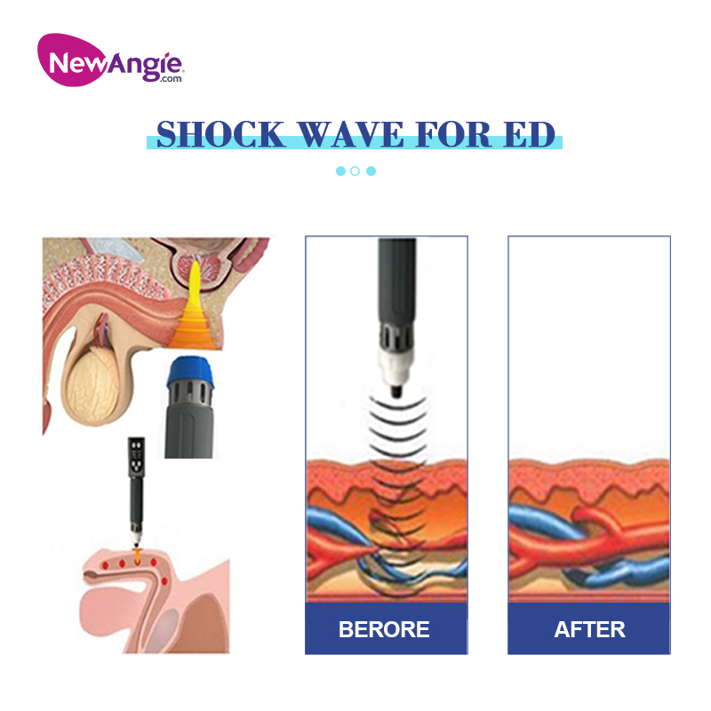 New Ems Shock Wave Machine Erectile Dysfunction Treatment Equipment SW17