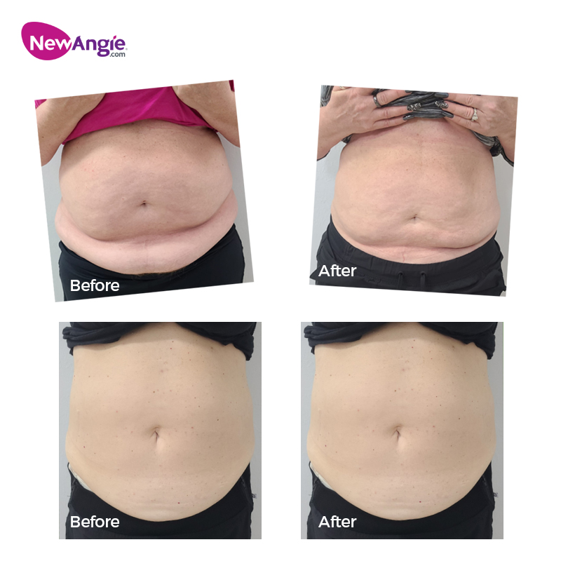Newangie® Green Laser Body Slimming Machine - LS659