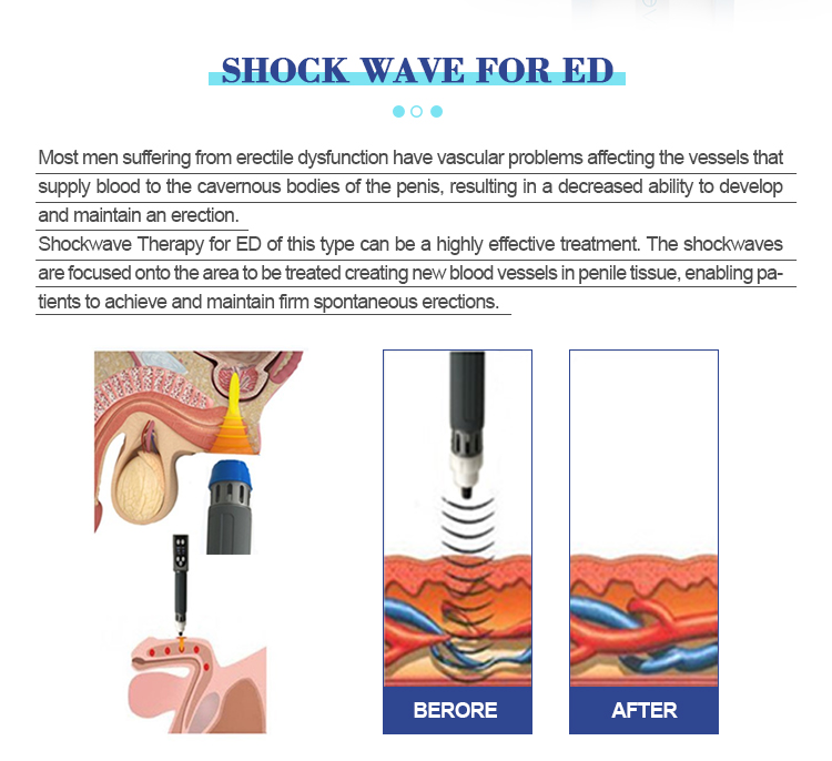 Double Handle ED Shockwave Therapy Machine Electromagnetic Shock Wave For  Cellulite And Body Contouring SW17 - Buy Shockwave Therapy Machine, ED Shockwave  Therapy Machine, shockwave machine cost Product on Newangie